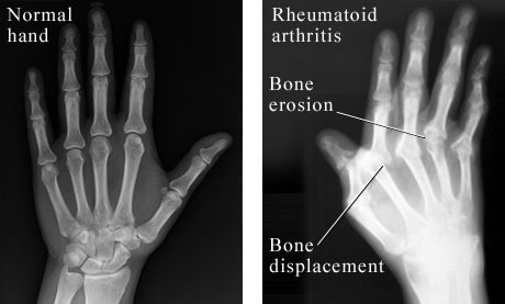 Rheumatoid Arthritis